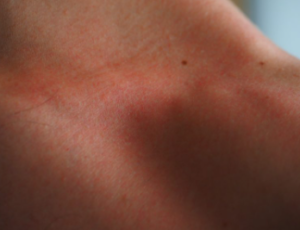 itchiness